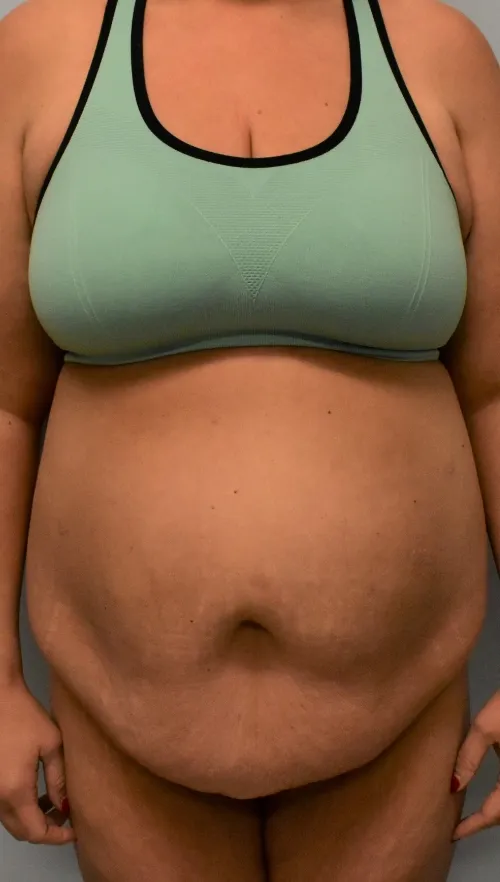 Tummy Tuck patient 2, before