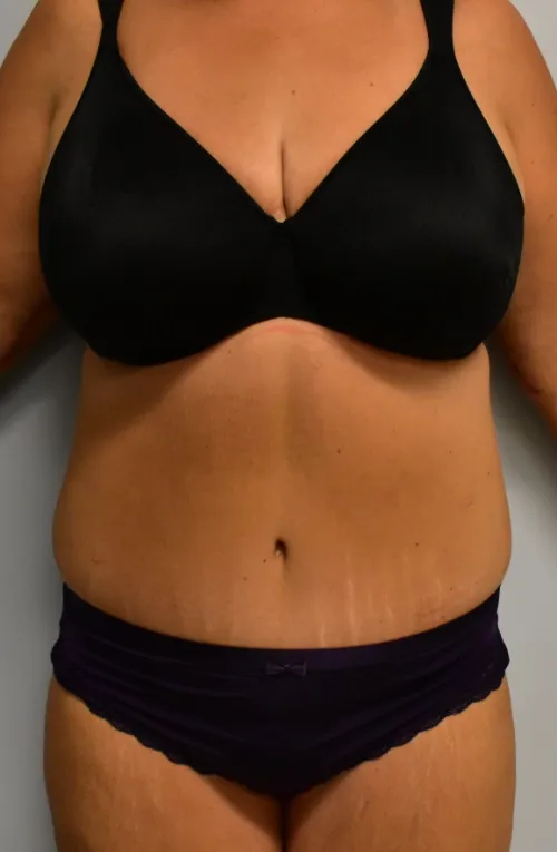 Tummy Tuck patient 2, after