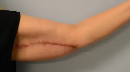 Arm Lift patient 2, after