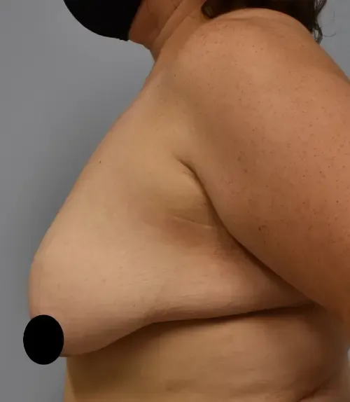 Breast Lift patient 13, before