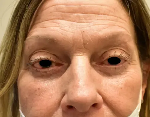 Eyelid Lift (Blepharoplasty) patient 3, after