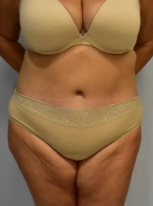 Tummy Tuck patient 4, after