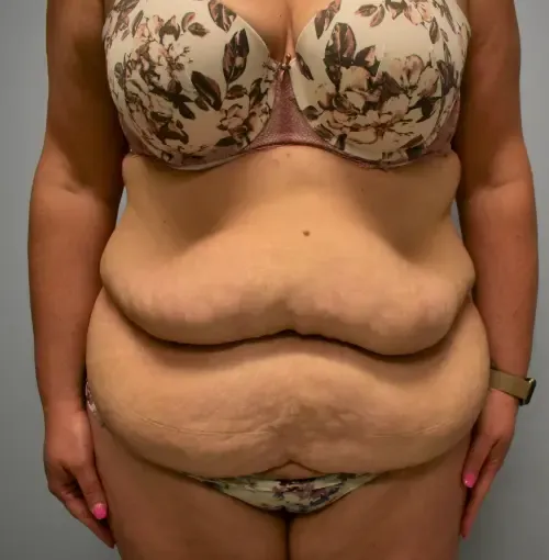 Tummy Tuck patient 4, before