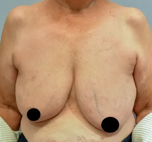 Breast Lift patient 6, before