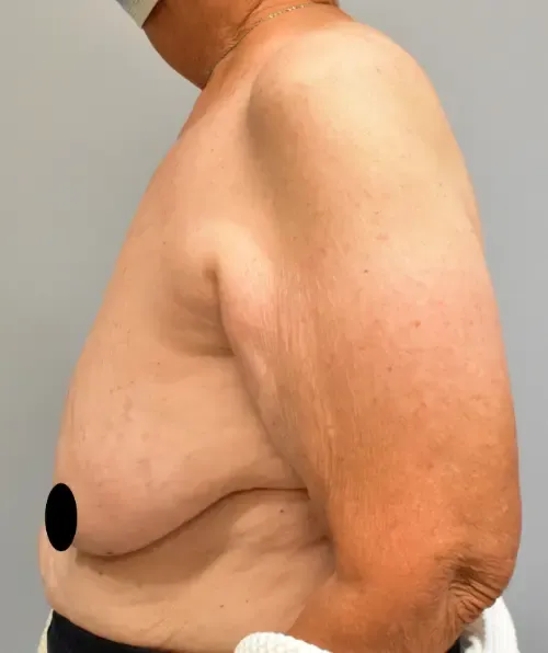 Breast Lift patient 8, before