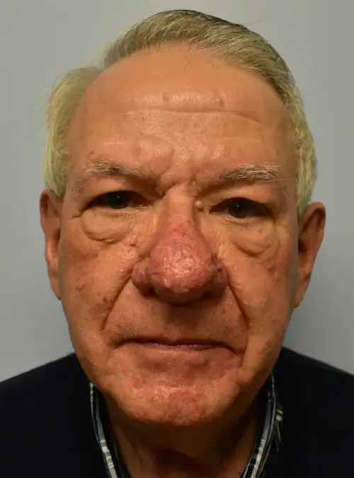 Rhinoplasty patient 1, before