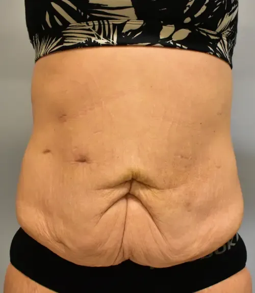 Tummy Tuck patient 6, before