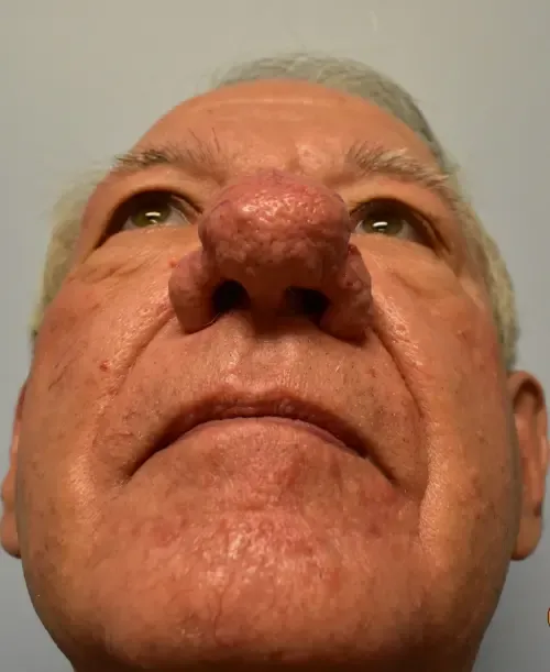 Rhinoplasty patient 2, before