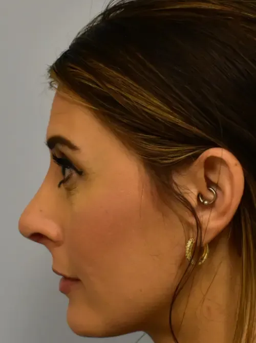 Rhinoplasty patient 5, after