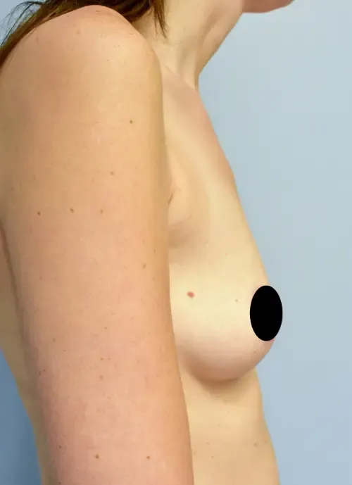 Breast Augmentation patient 5, before