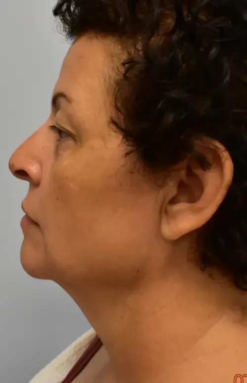Facelift patient 1, before