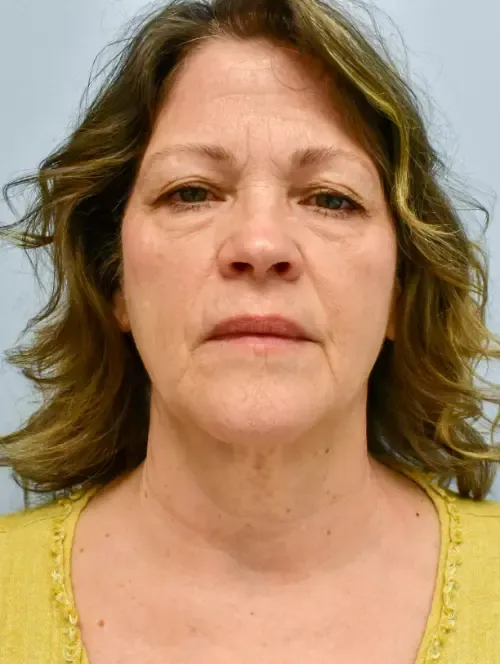 Facelift patient 2, before