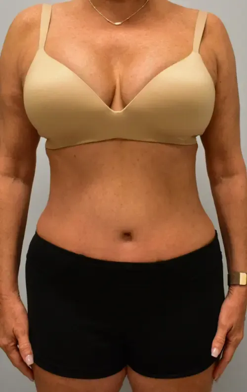 Tummy Tuck patient 8, after