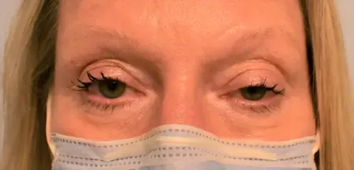 Eyelid Lift (Blepharoplasty) patient 2, before