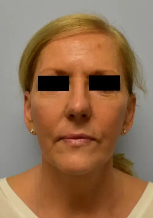 Facelift patient 6, after