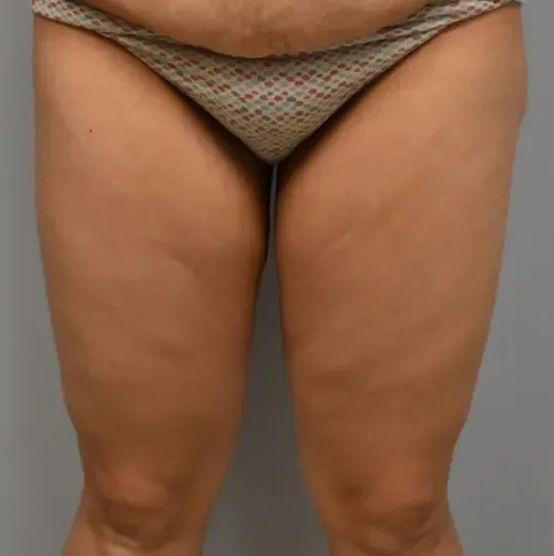 Thigh Lift patient 3, before