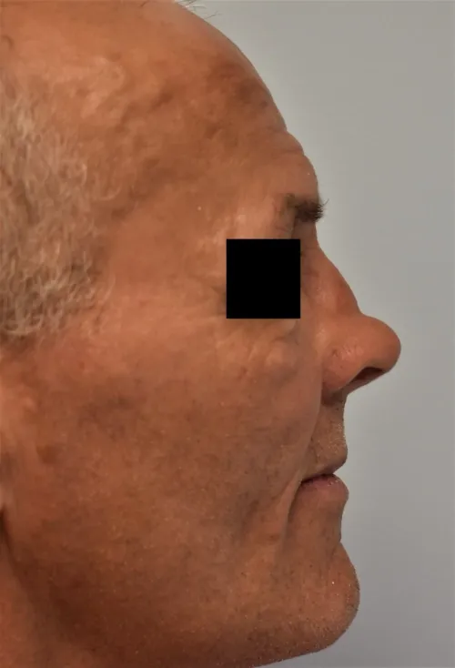 Rhinoplasty patient 12, before