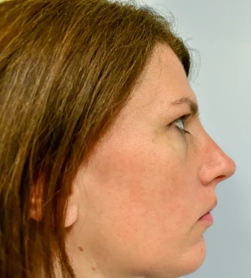 Rhinoplasty patient 8, after