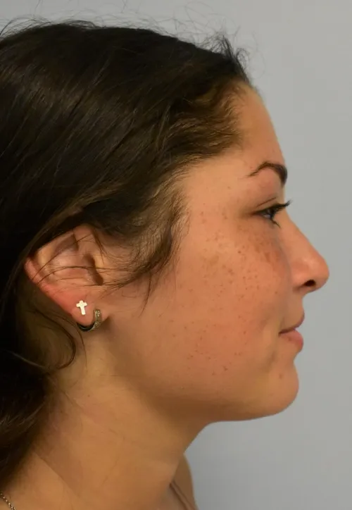 Rhinoplasty patient 14, after