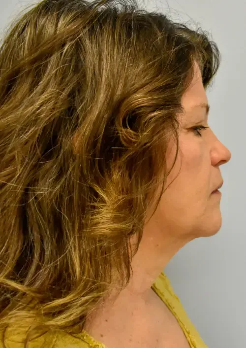 Facelift patient 3, before