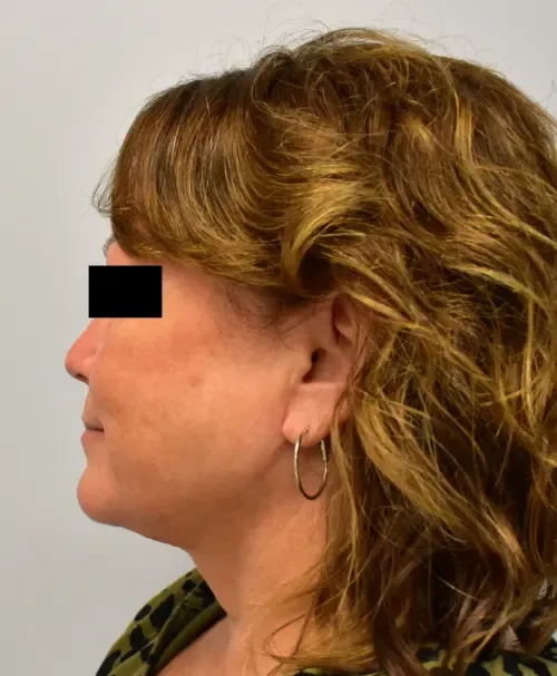 Facelift patient 5, after