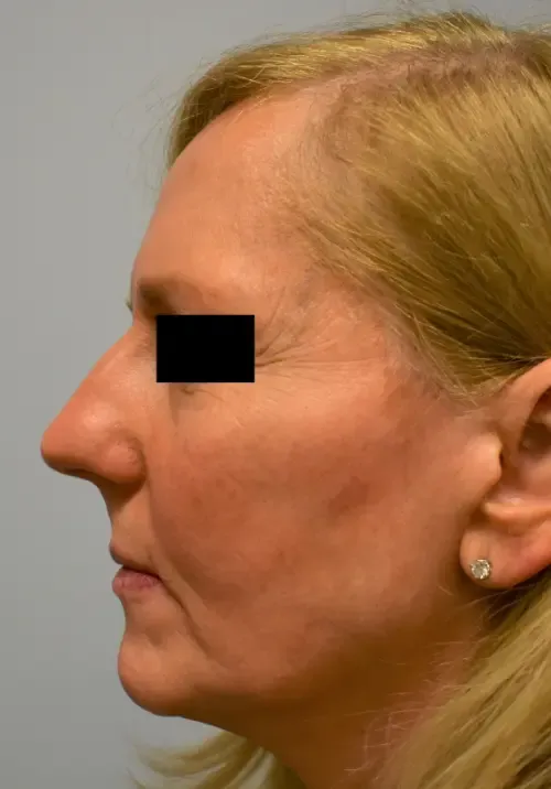 Facelift patient 7, before