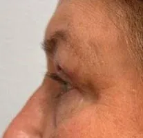 Eyelid Lift (Blepharoplasty) patient 6, after