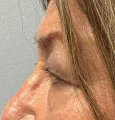 Eyelid Lift (Blepharoplasty) patient 6, before