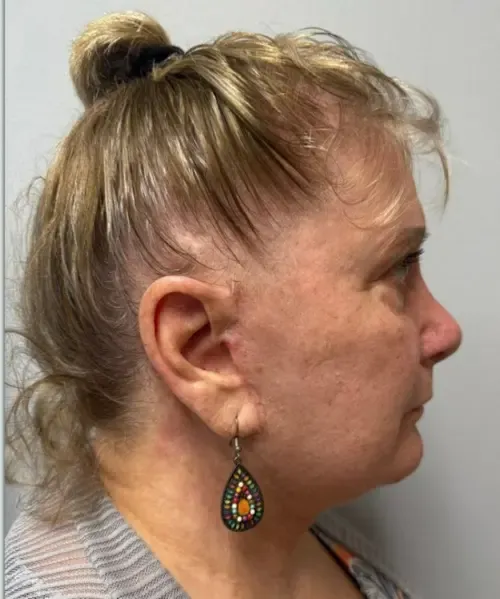 Facelift patient 9, after