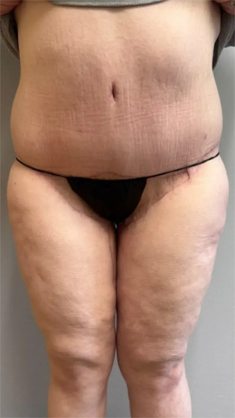 Tummy Tuck patient 14, after