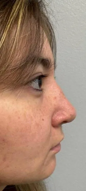Rhinoplasty patient 17, after