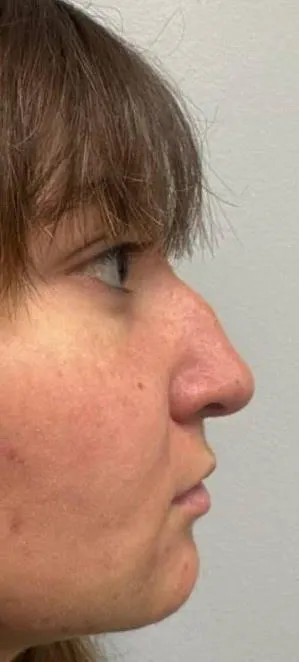 Rhinoplasty patient 17, before