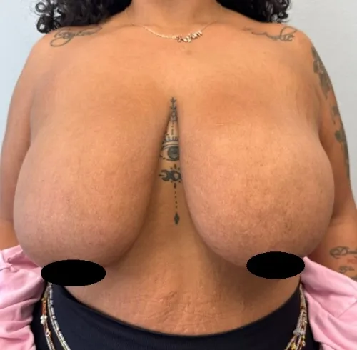 Breast Reduction patient 1, before