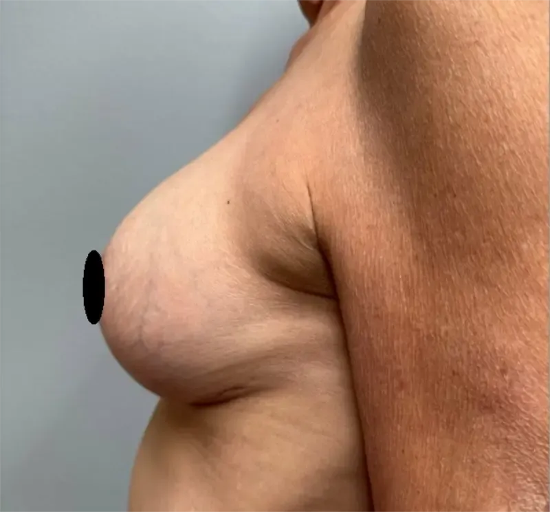 Breast Augmentation patient 10, after